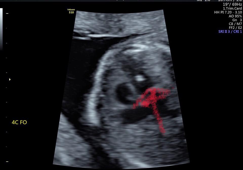 [懷孕] 14週心臟小白點