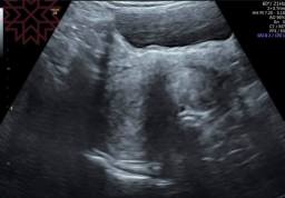 早期懷孕4周+5天腹部超音波的影像