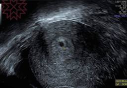 早期懷孕4周+5天經陰道超音波的影像